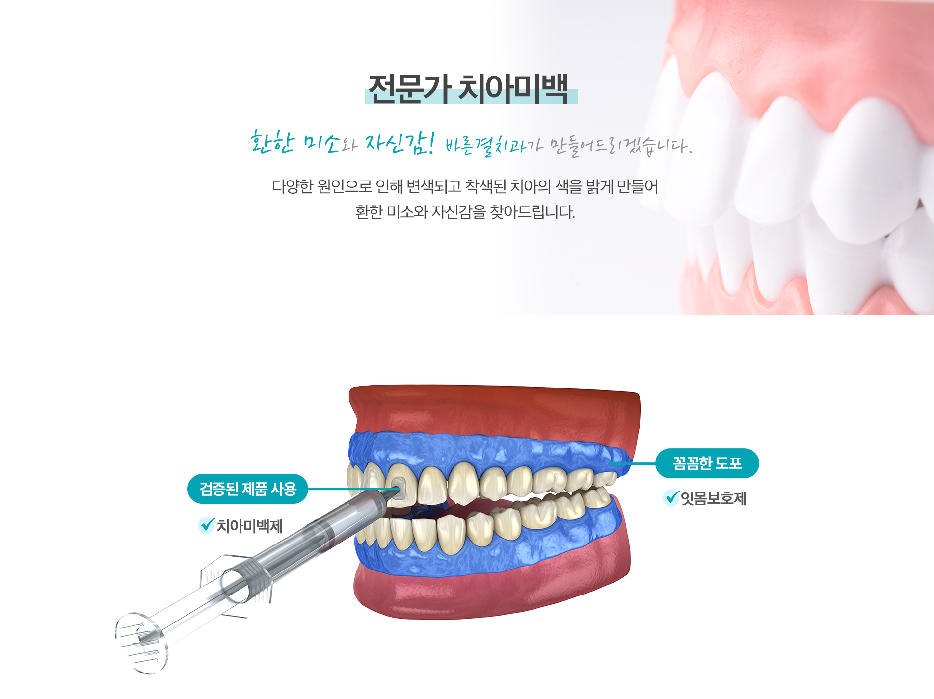 전문가 치아미백