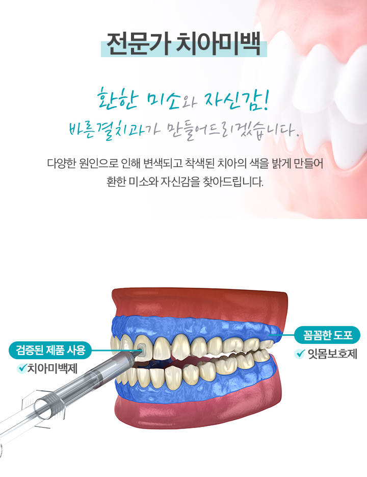 전문가치아미백