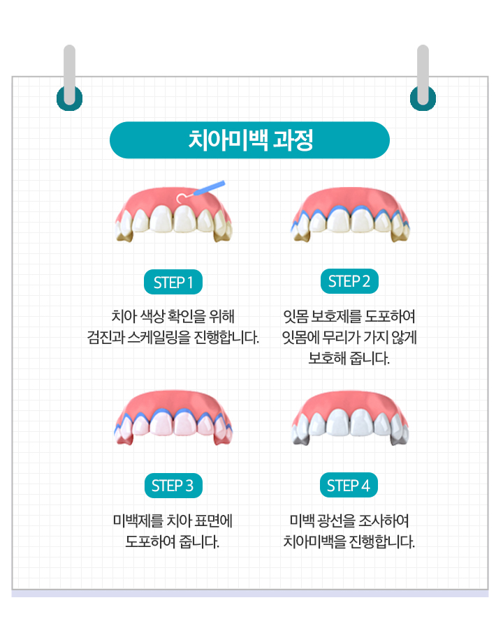 치아미백과정